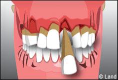 Les maladies des gencives