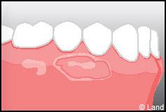 Chirurgie mucogingivale